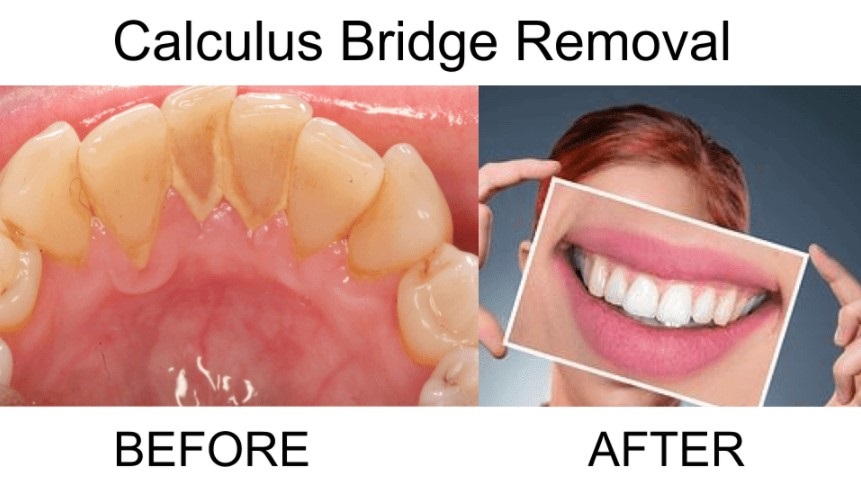 Removal of Calculus bridge