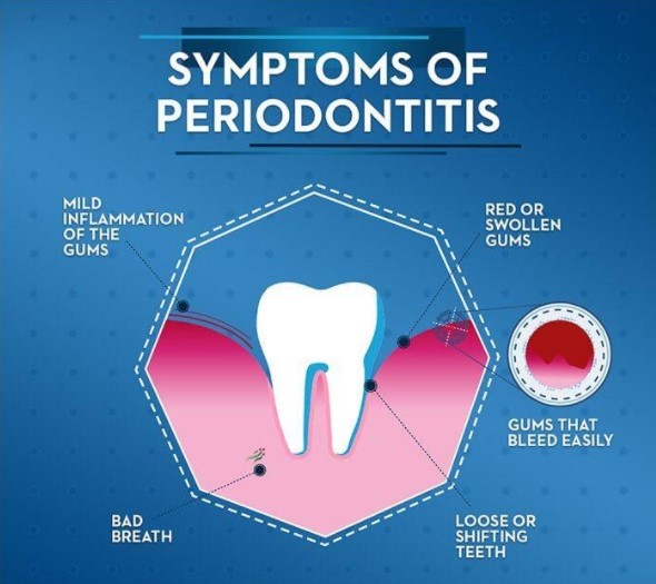 Significant Symptoms of Calculus Bridge