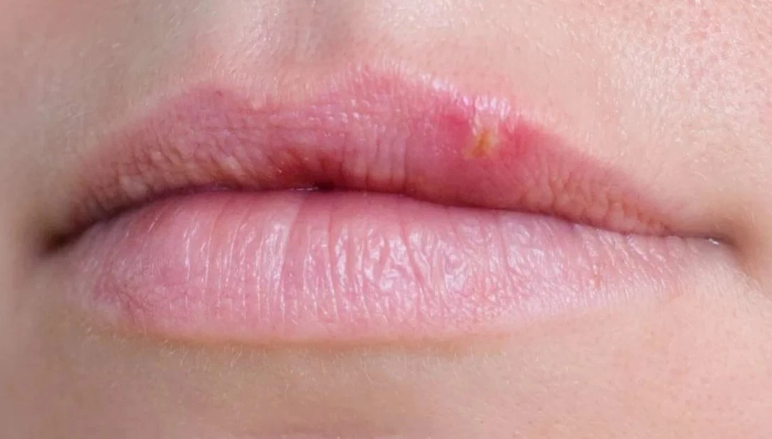 Types of tiny white bumps on lips