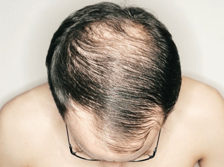 Regrow Hair and Save Your Bald Patches