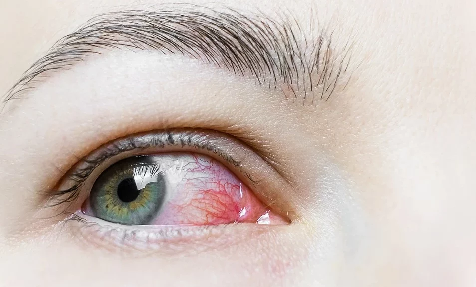 What is Commonly Misdiagnosed As Pink Eye